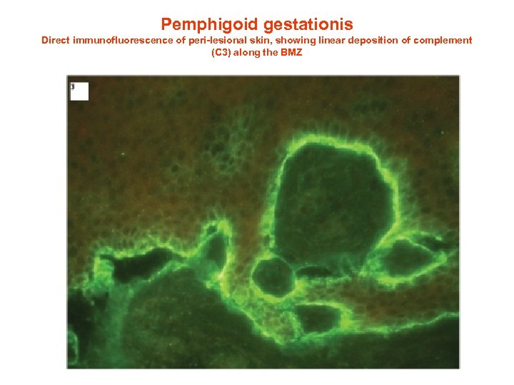 Pemphigoid gestationis Direct immunofluorescence of peri-lesional skin, showing linear deposition of complement (C 3)