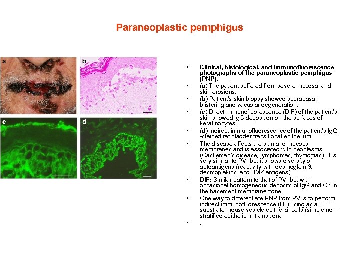 Paraneoplastic pemphigus • • • Clinical, histological, and immunofluorescence photographs of the paraneoplastic pemphigus