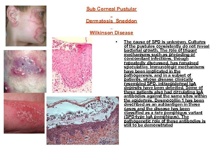 Sub Corneal Pustular Dermatosis Sneddon Wilkinson Disease • The cause of SPD is unknown.