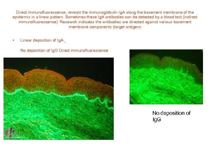 Direct immunofluorescence, reveals the immunoglobulin Ig. A along the basement membrane of the epidermis