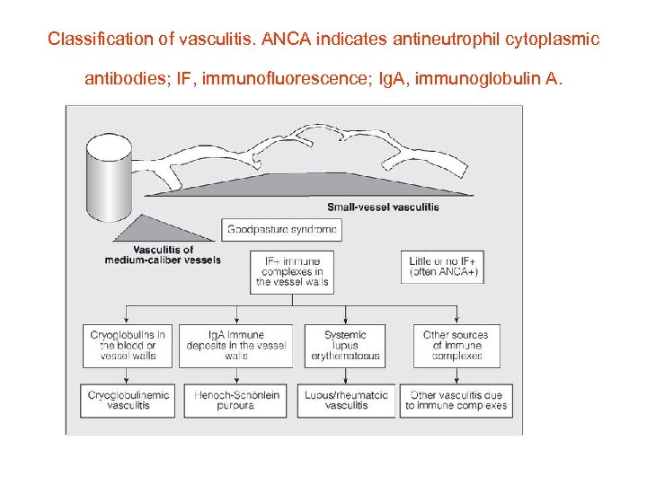 Classification of vasculitis. ANCA indicates antineutrophil cytoplasmic antibodies; IF, immunofluorescence; Ig. A, immunoglobulin A.