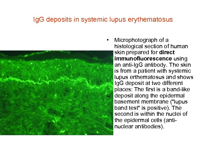 Ig. G deposits in systemic lupus erythematosus • Microphotograph of a histological section of