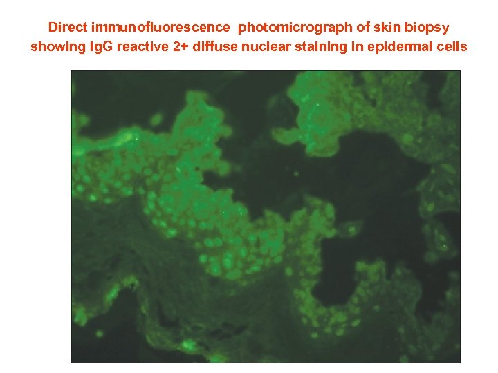  Direct immunofluorescence photomicrograph of skin biopsy showing Ig. G reactive 2+ diffuse nuclear