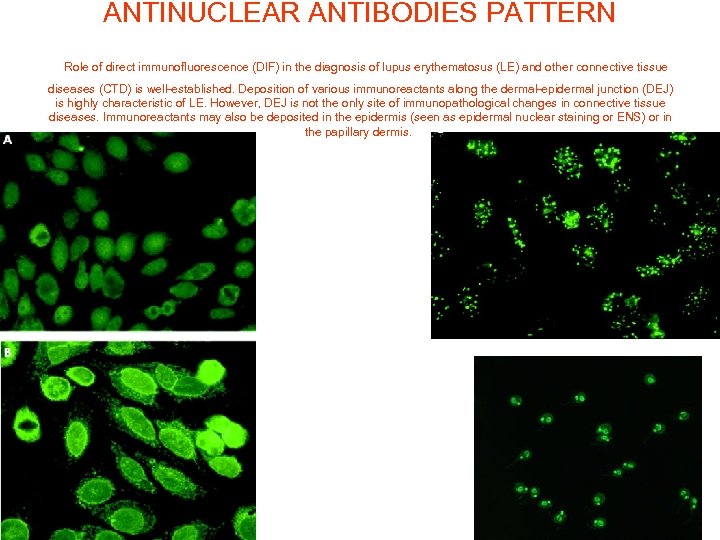 ANTINUCLEAR ANTIBODIES PATTERN Role of direct immunofluorescence (DIF) in the diagnosis of lupus erythematosus