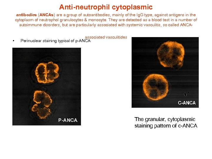 Anti-neutrophil cytoplasmic antibodies (ANCAs) are a group of autoantibodies, mainly of the Ig. G