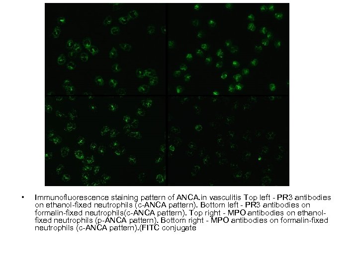  • Immunofluorescence staining pattern of ANCA. in vasculitis Top left - PR 3