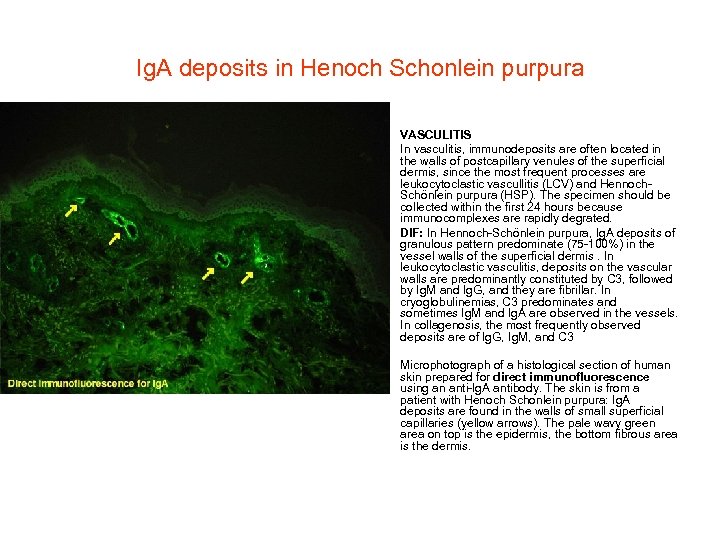 Ig. A deposits in Henoch Schonlein purpura • • VASCULITIS In vasculitis, immunodeposits are