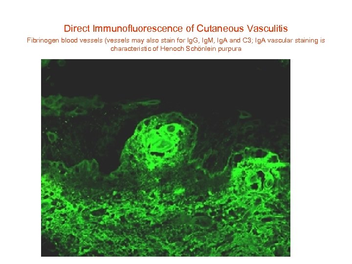 Direct Immunofluorescence of Cutaneous Vasculitis Fibrinogen blood vessels (vessels may also stain for Ig.