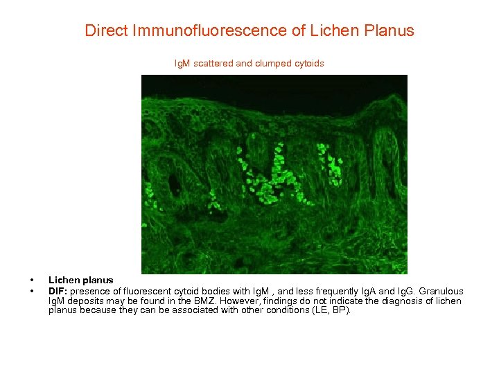 Direct Immunofluorescence of Lichen Planus Ig. M scattered and clumped cytoids • • Lichen