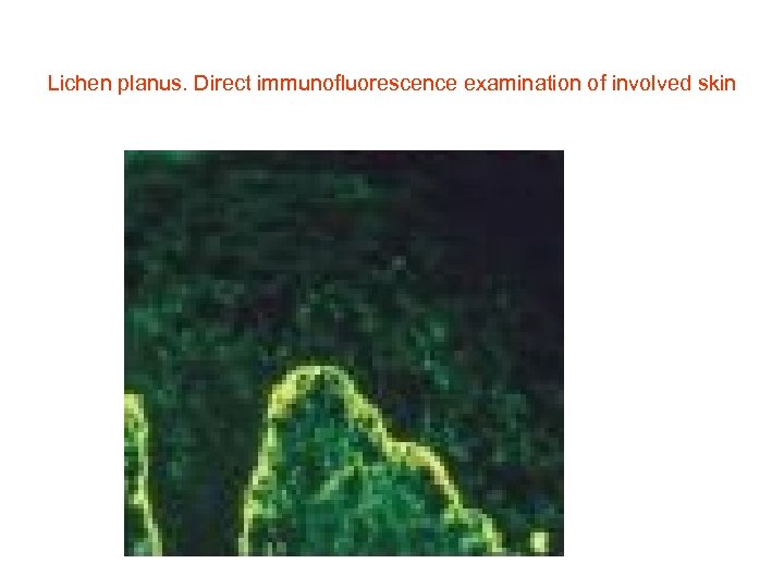 Lichen planus. Direct immunofluorescence examination of involved skin 