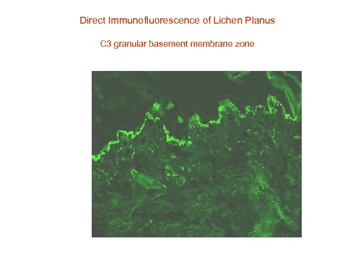 Direct Immunofluorescence of Lichen Planus C 3 granular basement membrane zone 