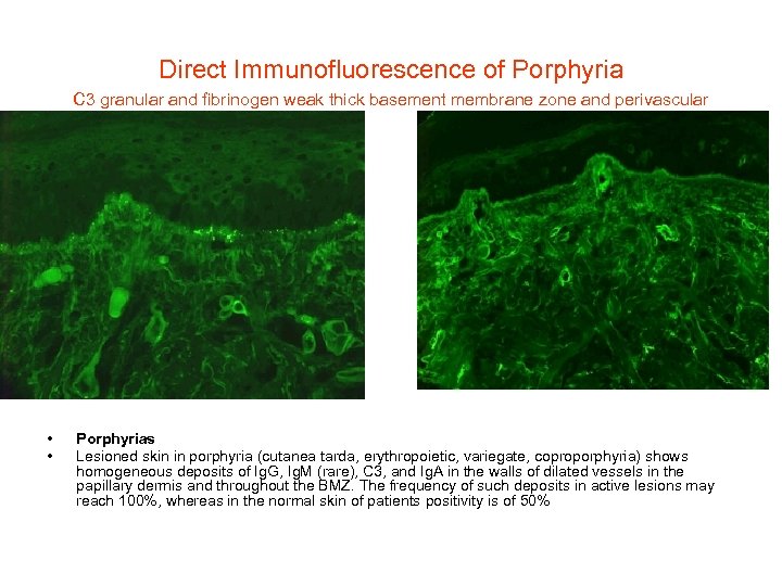 Direct Immunofluorescence of Porphyria C 3 granular and fibrinogen weak thick basement membrane zone