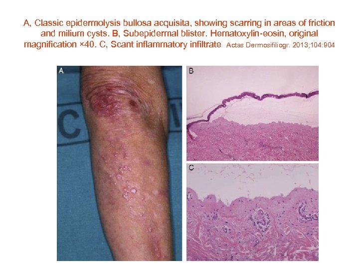 A, Classic epidermolysis bullosa acquisita, showing scarring in areas of friction and milium cysts.