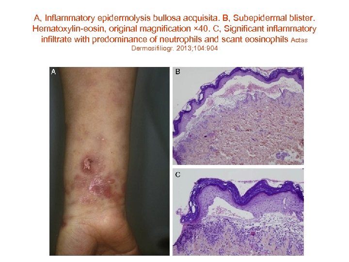 A, Inflammatory epidermolysis bullosa acquisita. B, Subepidermal blister. Hematoxylin-eosin, original magnification × 40. C,