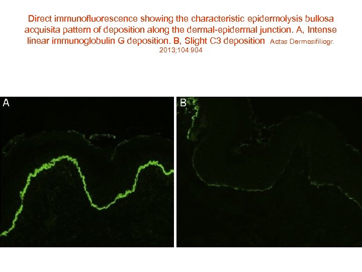 Direct immunofluorescence showing the characteristic epidermolysis bullosa acquisita pattern of deposition along the dermal-epidermal