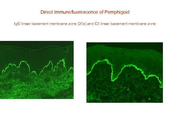 Direct Immunofluorescence of Pemphigoid Ig. G linear basement membrane zone (20 x) and C