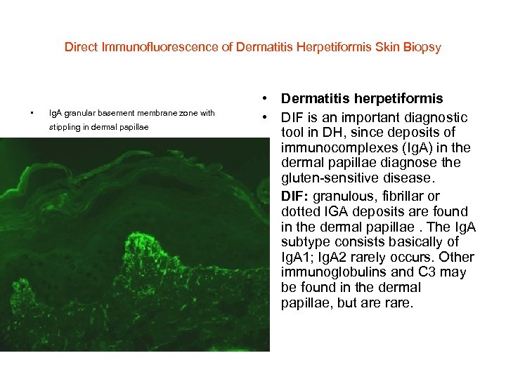 Direct Immunofluorescence of Dermatitis Herpetiformis Skin Biopsy • Ig. A granular basement membrane zone