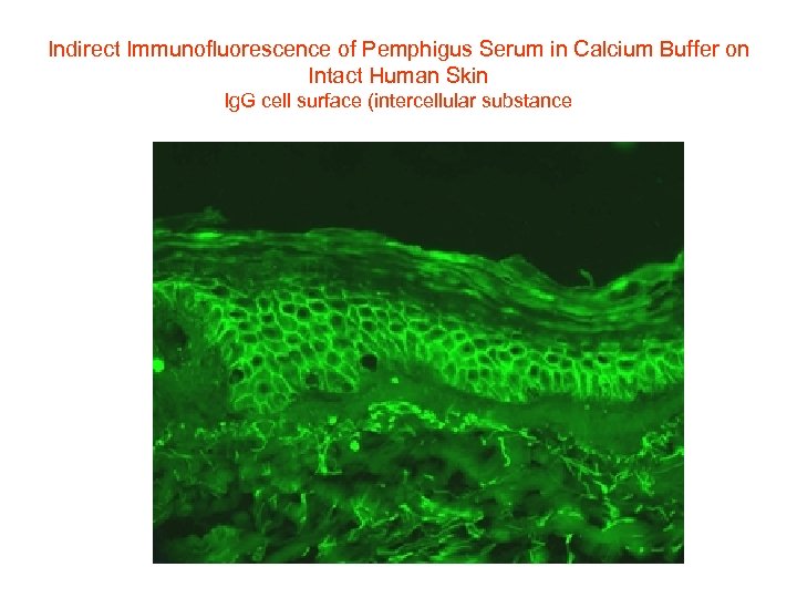 Indirect Immunofluorescence of Pemphigus Serum in Calcium Buffer on Intact Human Skin Ig. G