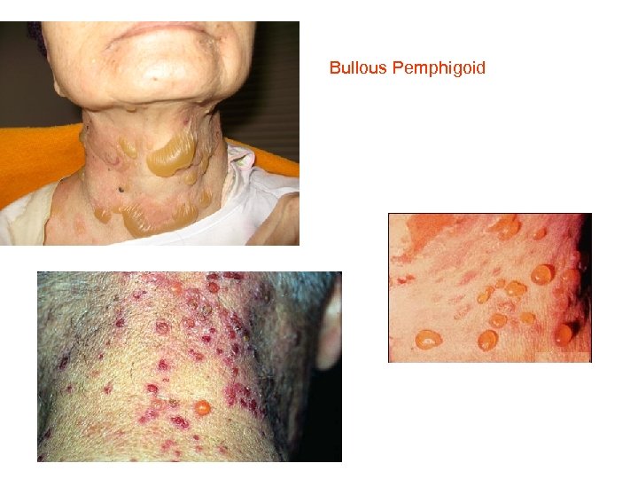  Bullous Pemphigoid 