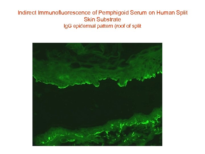 Indirect Immunofluorescence of Pemphigoid Serum on Human Split Skin Substrate Ig. G epidermal pattern