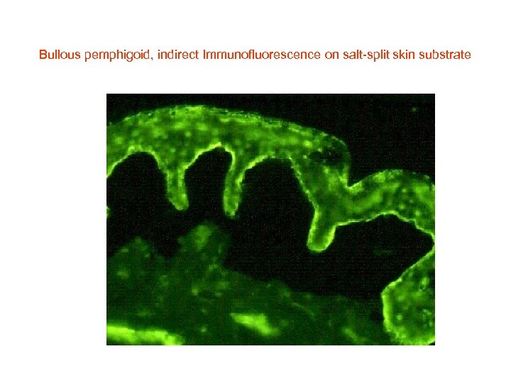 Bullous pemphigoid, indirect Immunofluorescence on salt-split skin substrate 