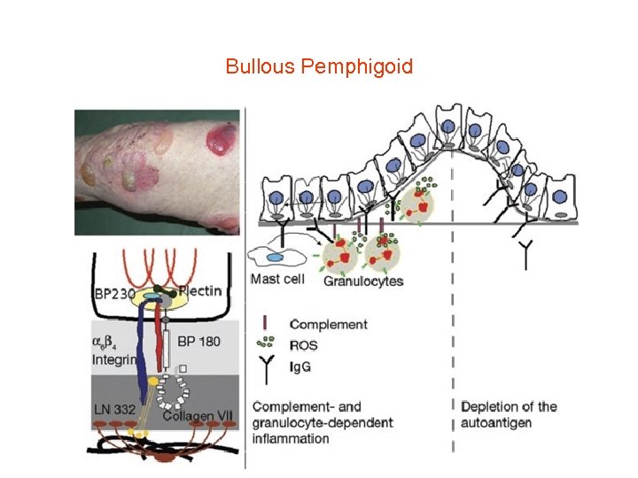 Bullous Pemphigoid 