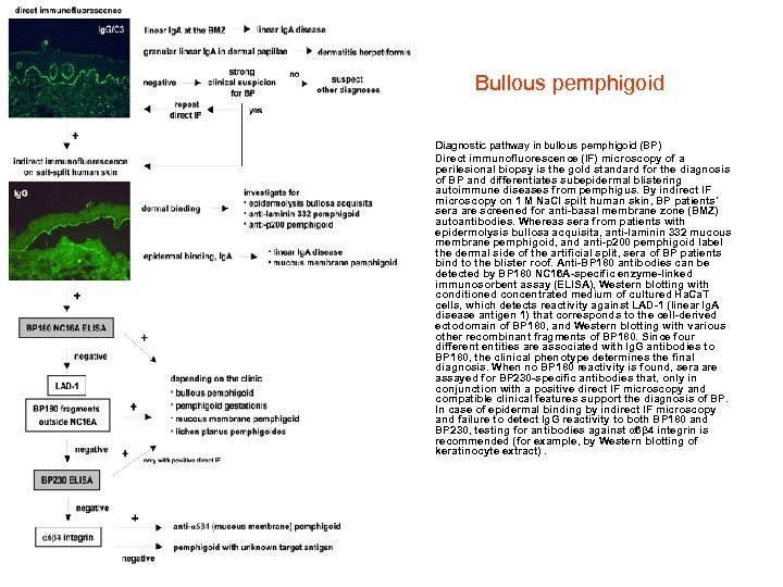  Bullous pemphigoid • • Diagnostic pathway in bullous pemphigoid (BP) Direct immunofluorescence (IF)