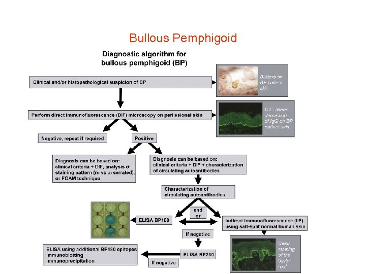 Bullous Pemphigoid 