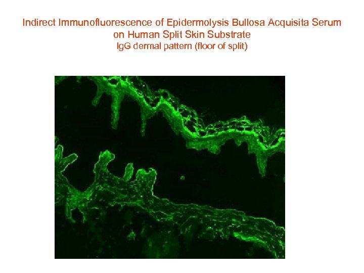 Indirect Immunofluorescence of Epidermolysis Bullosa Acquisita Serum on Human Split Skin Substrate Ig. G