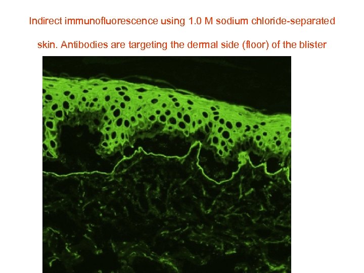 Indirect immunofluorescence using 1. 0 M sodium chloride-separated skin. Antibodies are targeting the dermal