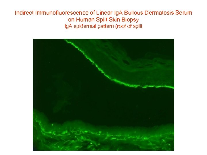 Indirect Immunofluorescence of Linear Ig. A Bullous Dermatosis Serum on Human Split Skin Biopsy