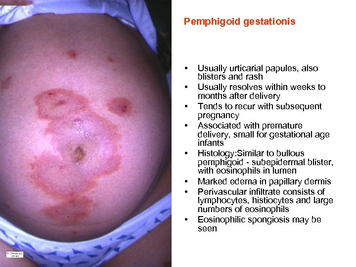  Pemphigoid gestationis • • Usually urticarial papules, also blisters and rash Usually resolves