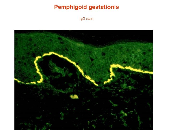 Pemphigoid gestationis Ig. G stain 