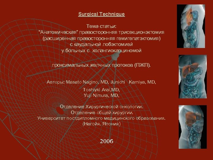 Surgical Technique Тема статьи: “Анатомическая” правосторонняя трисекционэктомия (расширенная правосторонняя гемигепатэктомия) с каудальной лобэктомией у