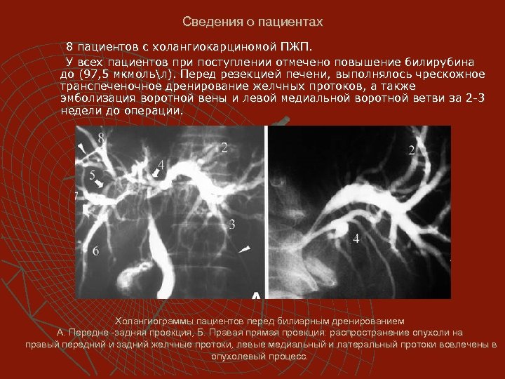 Сведения о пациентах 8 пациентов с холангиокарциномой ПЖП. У всех пациентов при поступлении отмечено