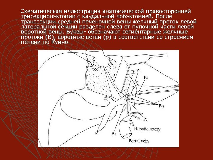 Схематическая иллюстрация анатомической правосторонней трисекционэктомии с каудальной лобэктомией. После транссекции средней печеночной вены желчный