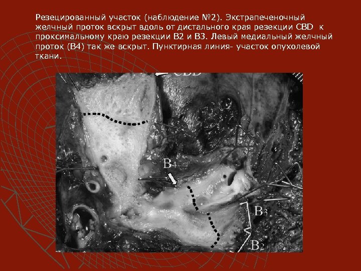 Резецированный участок (наблюдение № 2). Экстрапеченочный желчный проток вскрыт вдоль от дистального края резекции