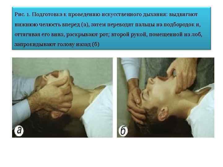 Рис. 1. Подготовка к проведению искусственного дыхания: выдвигают нижнюю челюсть вперед (а), затем переводят