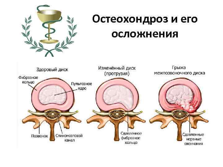 Остеохондроз и его осложнения 