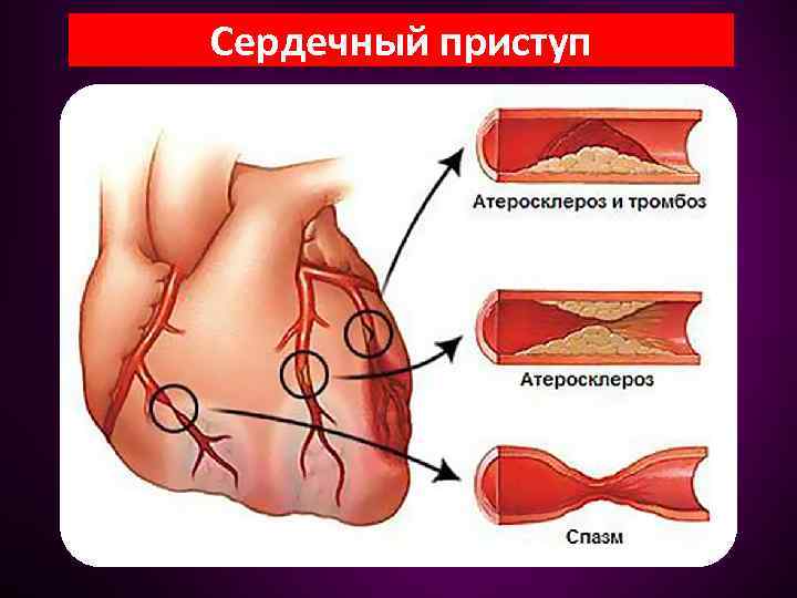 Сердечный приступ 