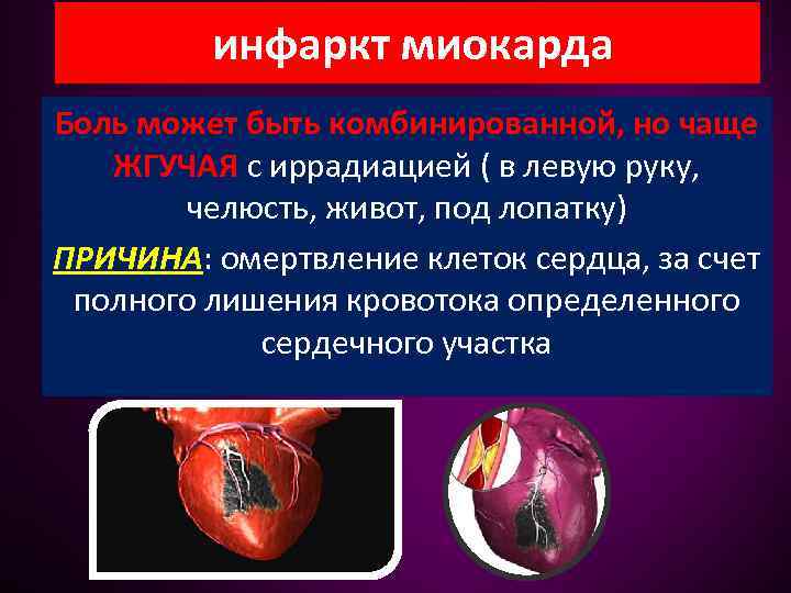 инфаркт миокарда Боль может быть комбинированной, но чаще ЖГУЧАЯ с иррадиацией ( в левую