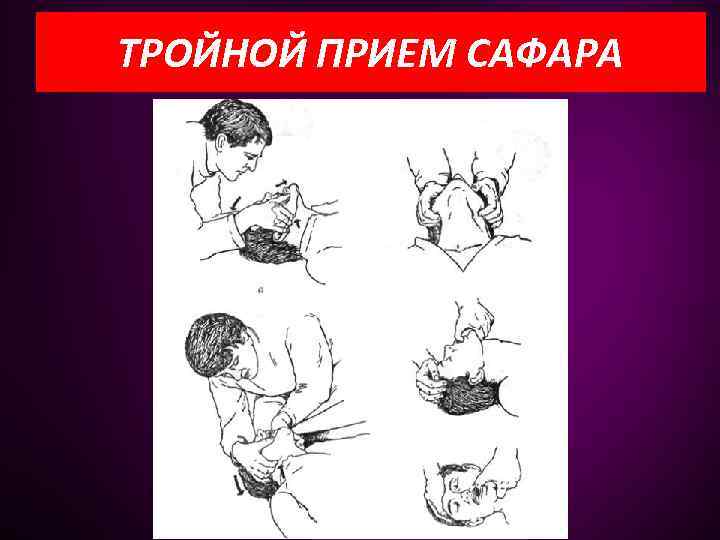 ТРОЙНОЙ ПРИЕМ САФАРА 