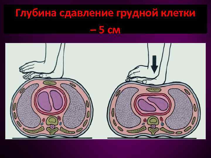 Глубина сдавление грудной клетки – 5 см 