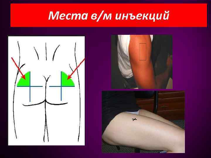 Места в/м инъекций 