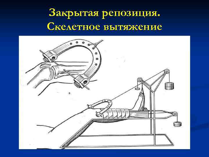 Закрытая репозиция. Скелетное вытяжение 