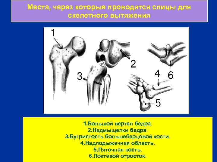 Места, через которые проводятся спицы для скелетного вытяжения 1. Большой вертел бедра. 2. Надмыщелки