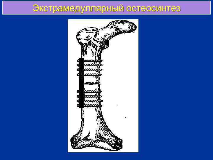 Экстрамедуллярный остеосинтез 