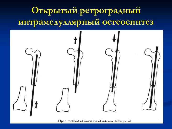 Открытый ретроградный интрамедуллярный остеосинтез 