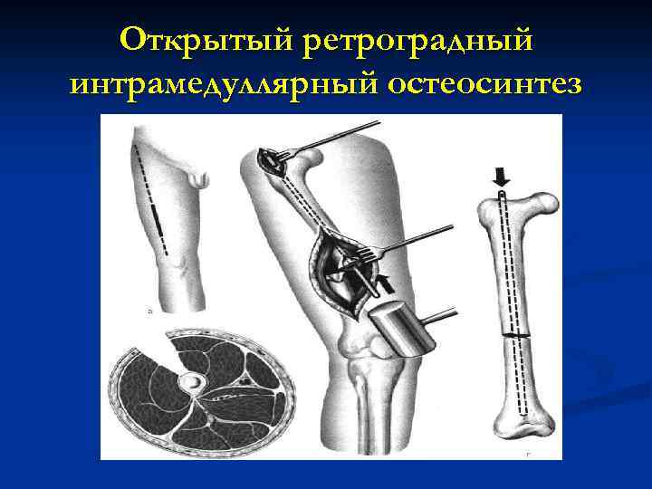 Открытый ретроградный интрамедуллярный остеосинтез 