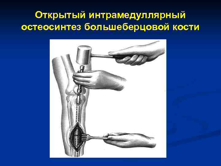 Открытый интрамедуллярный остеосинтез большеберцовой кости 